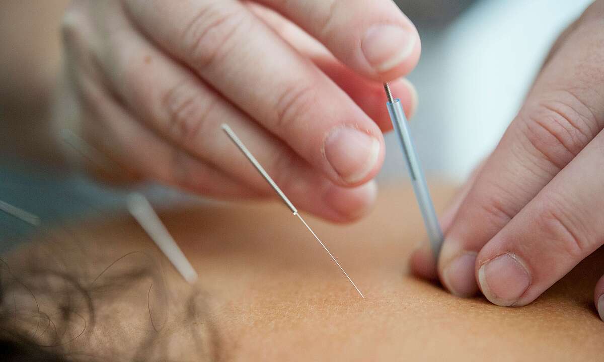 Arrêter de fumer grâce à l’acupuncture : mythe ou réalité ?